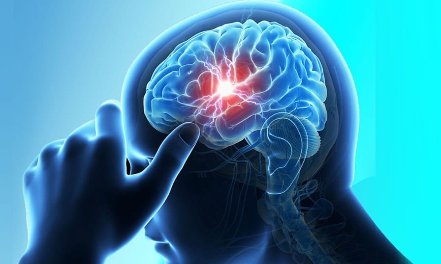 Brain-Stroke_78dNtyrogc